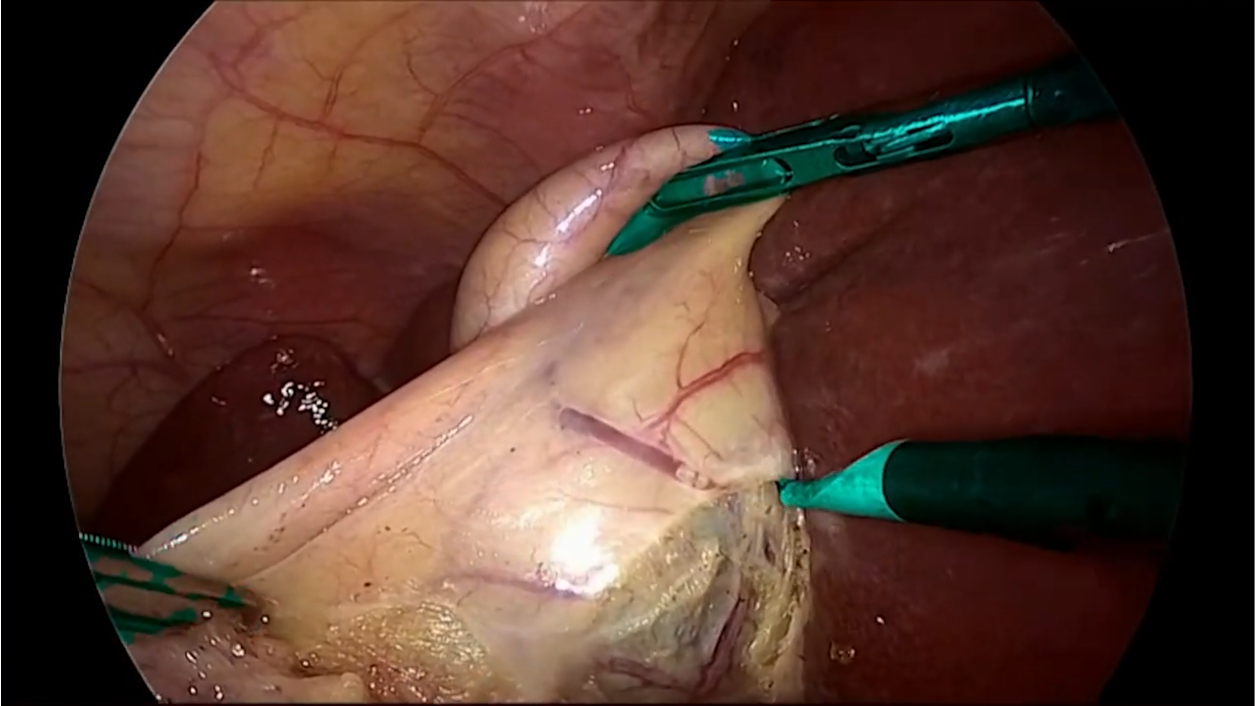Endoscopy Use Case