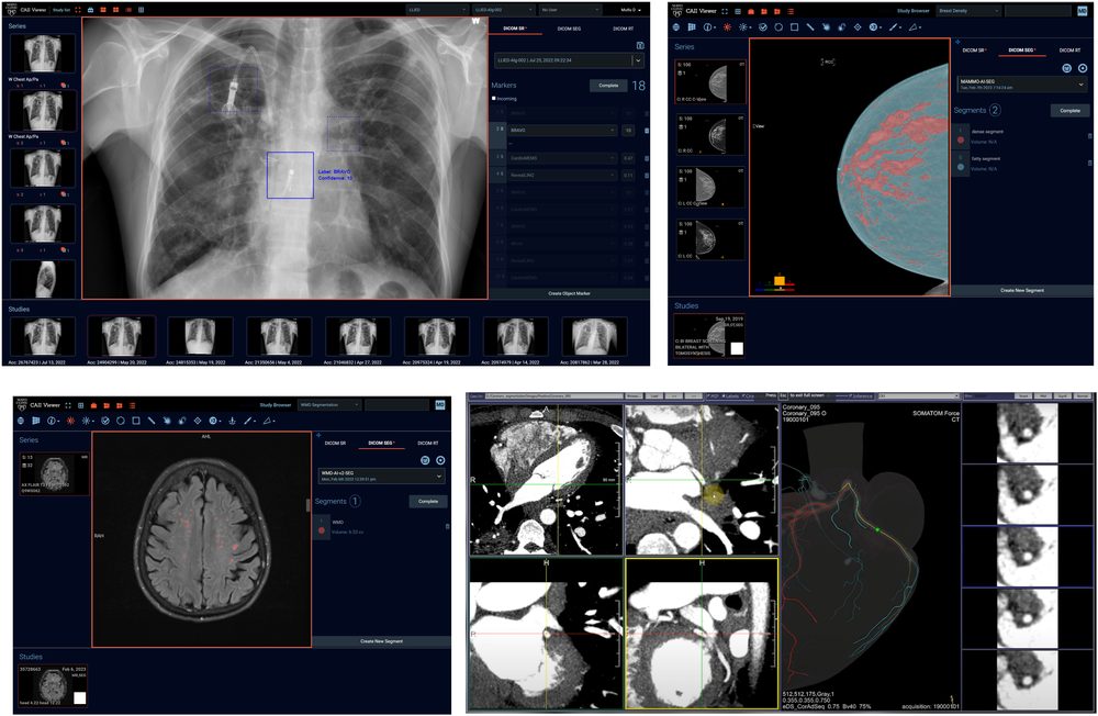 MONAI models running in the CAII clinical viewer at Mayo Clinic